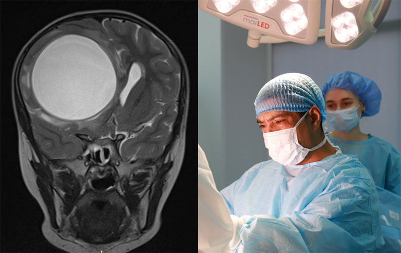 Новосибирские хирурги извлекли огромную эхинококковую кисту из мозга пятилетней девочки
