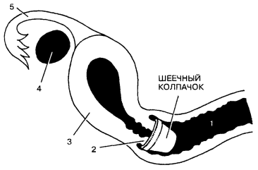 Расположение шеечного колпачка во влагалище